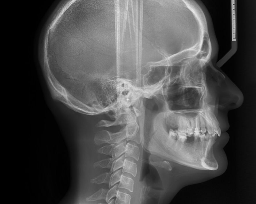 Röntgenbild Schädel