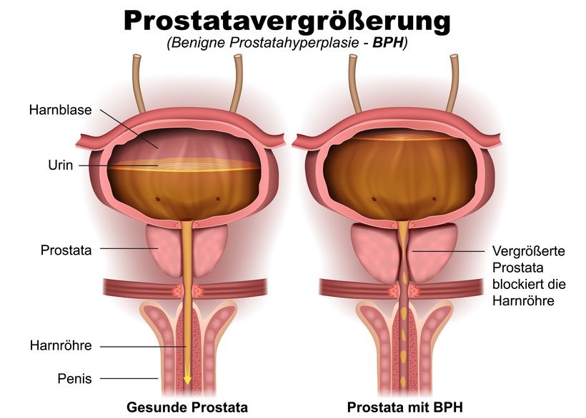Prostatahyperplasie / Prostatavergrösserung