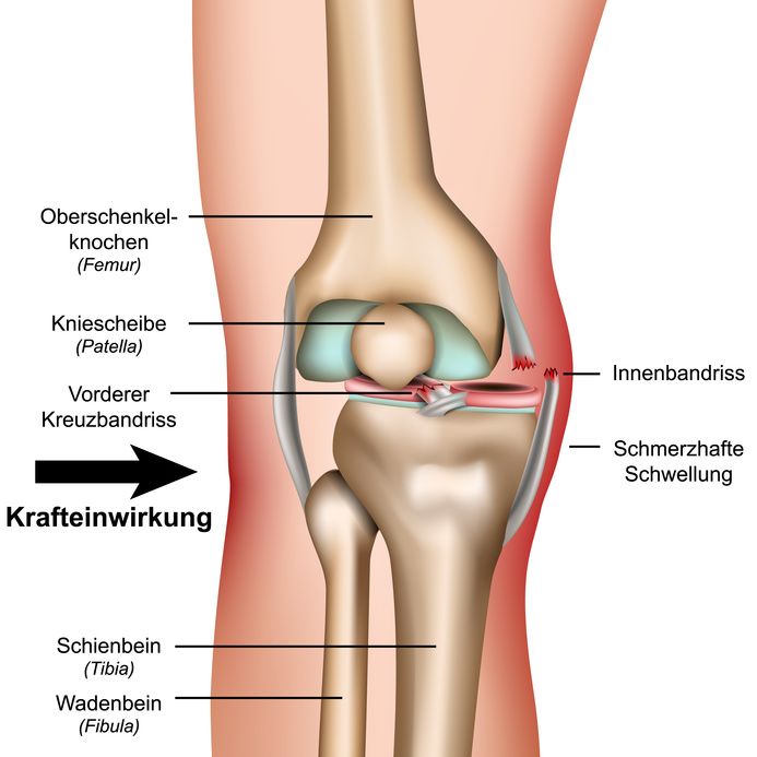 Außenbandriss Knie Symptome
