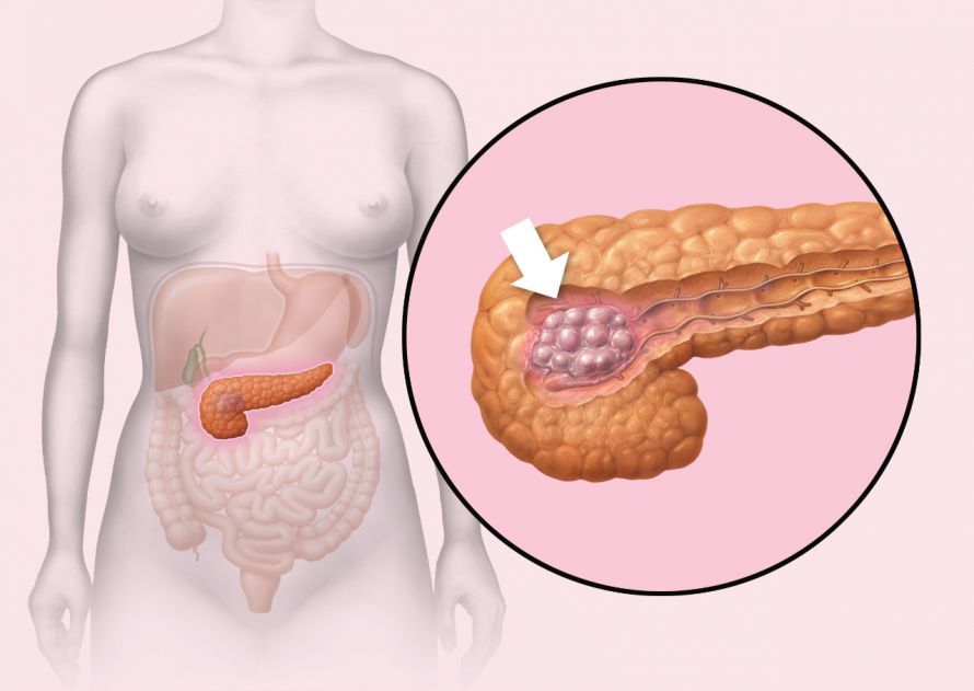 Darstellung von Bauchspeicheldrüsenkrebs