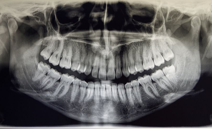 Röntgenbild des Kiefers