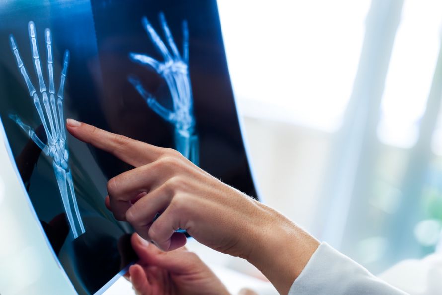 Röntgenbild bei Lunatummalazie