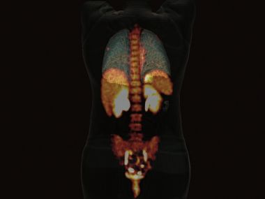 PET/CT Gerät Biograph Horizon Siemens - Bild Lungenknoten